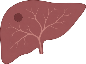 Hepatocellular Carcinoma