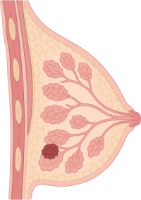 Breast Cancer