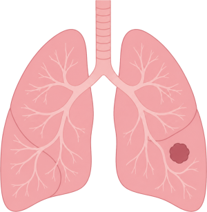 Lung Cancer