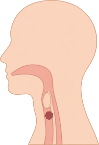 Head & Neck Cancer