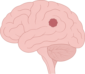 Brain Tumor (Glioma)
