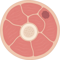 Sarcoma