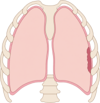 Mesothelioma