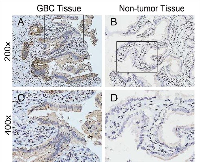 cIAP1 expression in gallbladder cancer (GBC) tissues and non-tumor tissues.