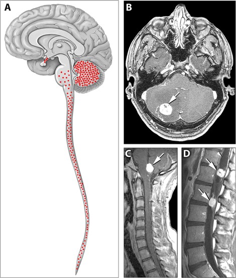 Distribution of hemangioblastomas in the central nervous systems.