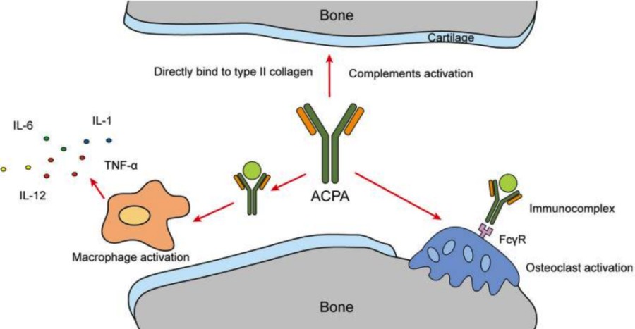 Fig. 1 ACPA bone destruction structure. (OA Literature)