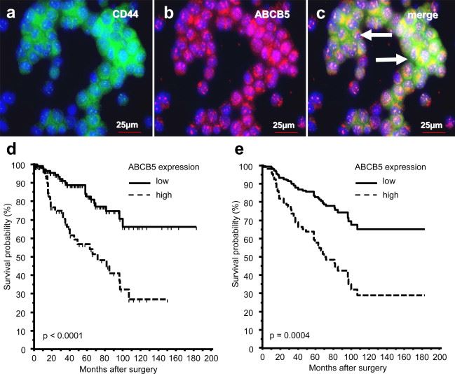 Immunofluorescence double labeling of ABCB5 with CD44 and survival curves of oral squamous cell carcinoma (OSCC) patients measured by ABCB5 expression.