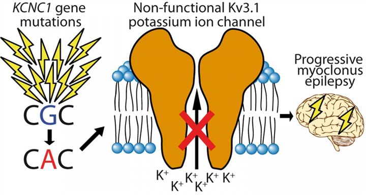 Mutations (lightning bolts) in 13 unrelated cases hit the same DNA nucleotide in <em>KCNC1</em> gene and disrupt the function of a potassium ion channel, which causes a severe form of epilepsy.