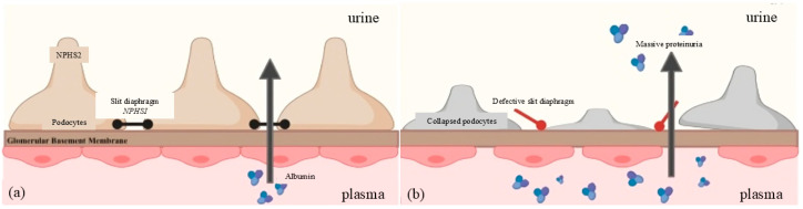 Fig. 1 NPHS2-mediated glomerular slit diaphragm homeostasis and nephrotic syndrome pathological dual comparison schematic for podocyte and hereditary glomerulopathy research reagents. (OA Literature)