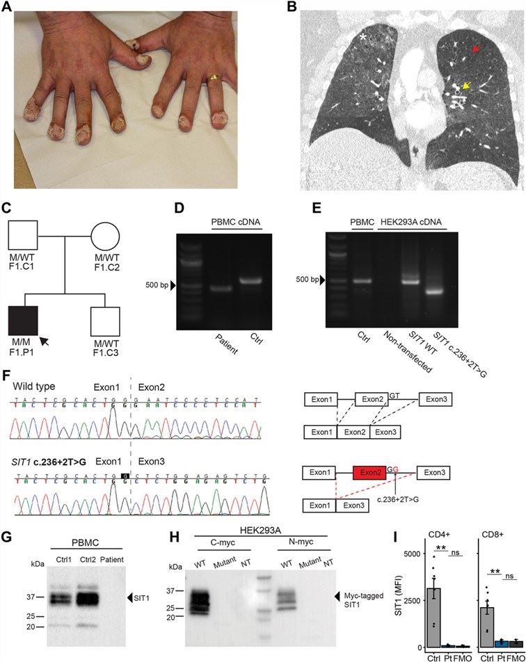 Fig.1 Identification of SIT1 homozygous variant. (OA Literature)