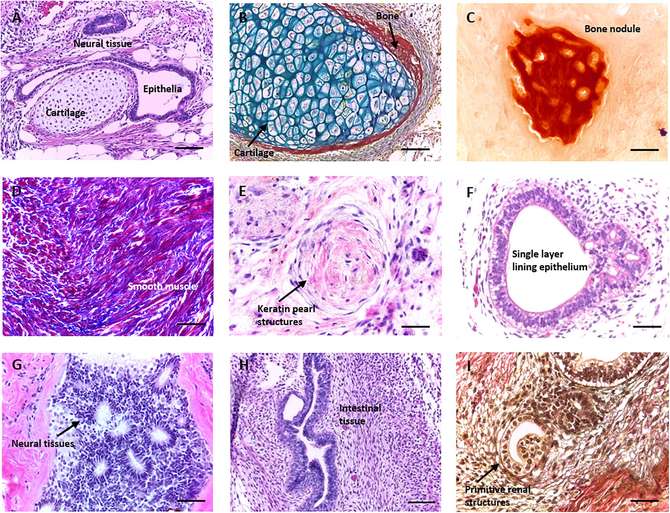 Teratoma was stained and analyzed using different staining methods. (OA Literature)
