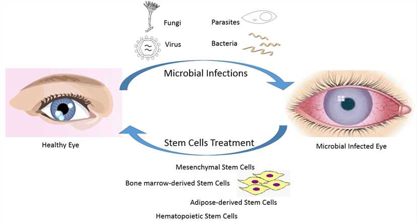 Treatment of ocular microbial infections by iPSCs.