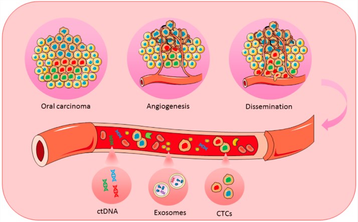 Schematic representation of CTCs, ctDNA, and exosomes for achieving personalized medicine in oral cancer. 