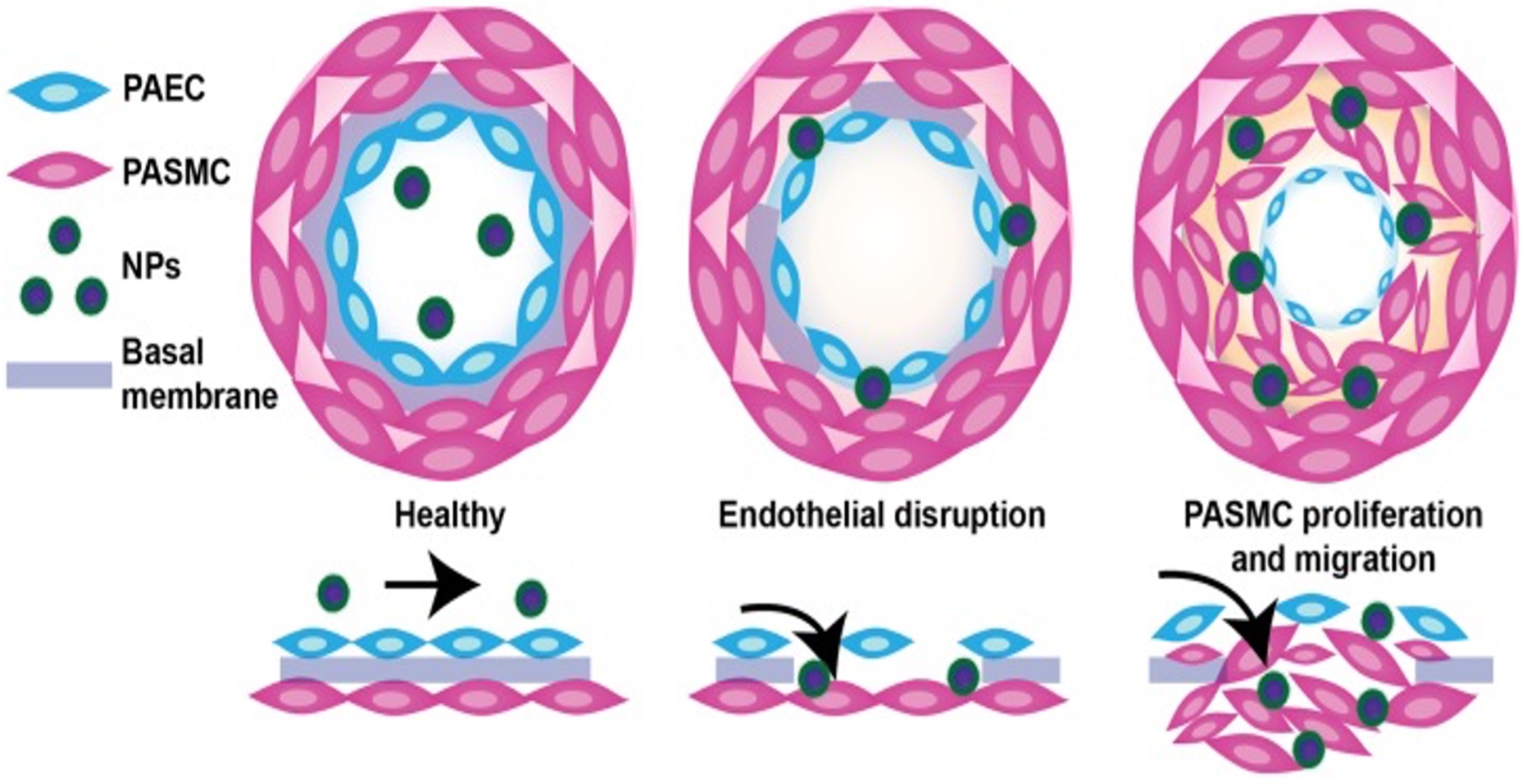Fig. 1 A picture of endothelial dysfunction in PAH and a proposed mechanism of NP extravasation into pulmonary vasculature. (OA Literature)