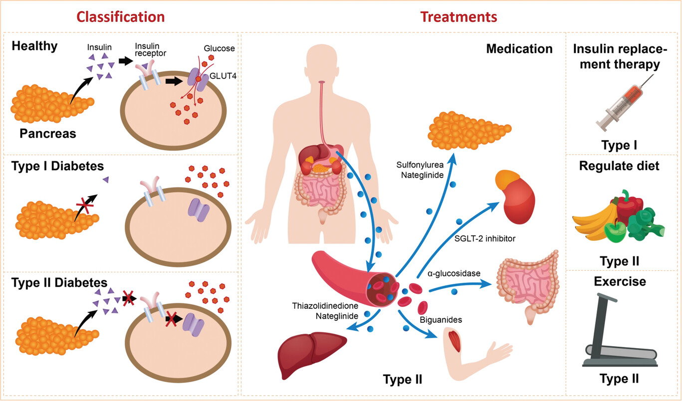 Fig 1. Diabetes classifications and approaches for management. (OA Literature)