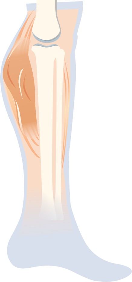 Fig.1 An image of fibrosarcoma. (Creative Biolabs Original)
