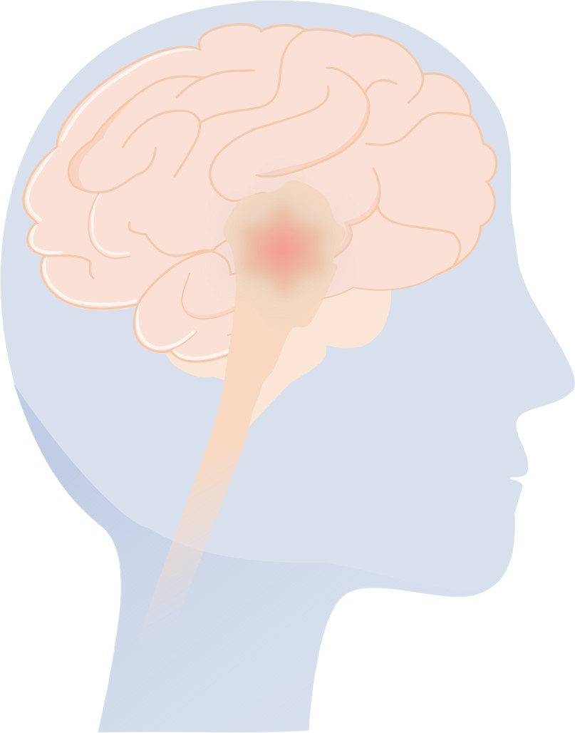 Fig.1 An image of glioma. (Creative Biolabs Original)