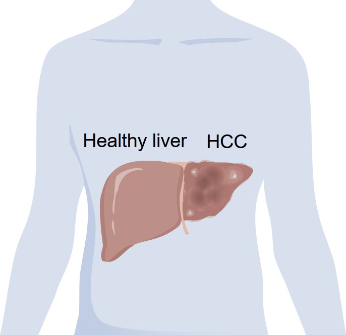 Fig.1 An image of glioma. (Creative Biolabs Original)