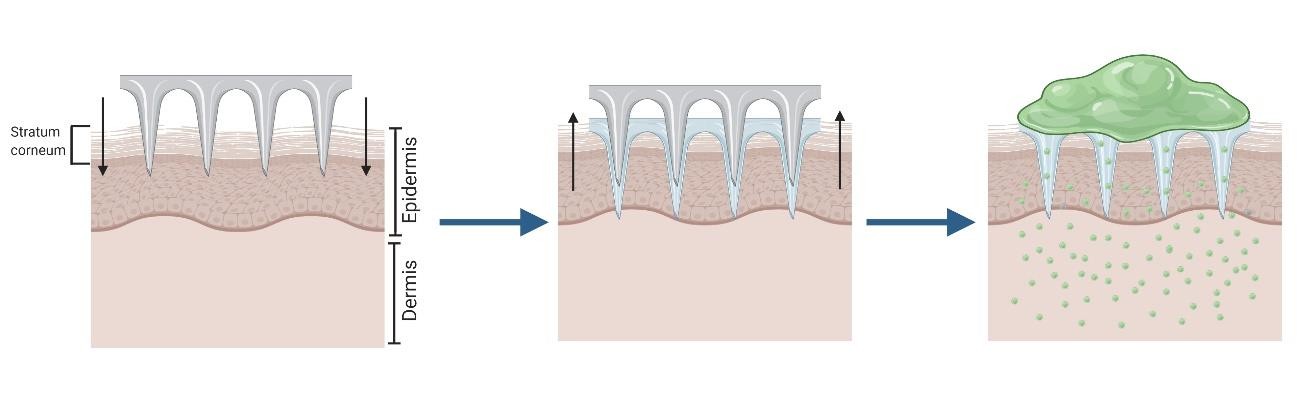 Illustration of the 'poke and patch' approach with solid microneedle arrays (MNA): Solid microneedles penetrate the stratum corneum, then a drug patch is applied to deliver actives through the created microchannels, explaining this microneedle-based drug delivery strategy. (OA Literature)