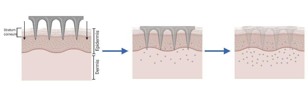 Illustration of the 'poke and release' approach with dissolving microneedles: Microneedles penetrate the stratum corneum, then dissolve within the skin to release drug actives, demonstrating this microneedle-based drug delivery strategy. (OA Literature)