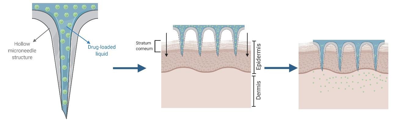 Illustration of the 'poke and flow' approach with hollow microneedles: Hollow microneedles loaded with drug-containing liquid penetrate the stratum corneum, allowing the liquid formulation to flow into the skin for targeted drug delivery, a key microneedle-based strategy in modern drug delivery. (OA Literature)