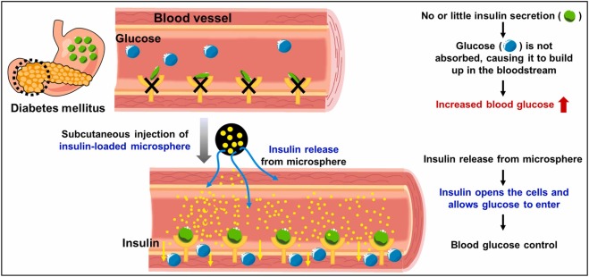 Illustration showing how insulin-loaded microspheres treat diabetes: In diabetes, little insulin leads to glucose buildup; microspheres release insulin to open cells, let glucose enter, and control blood glucose. (OA Literature)