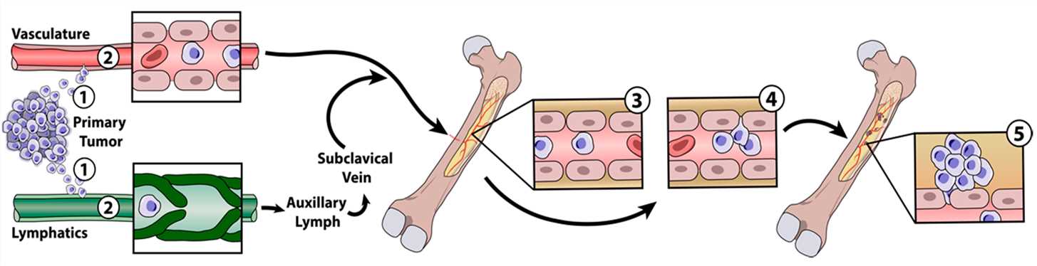 Fig.1 Mechanism of bone metastasis. (Adjei, Isaac M., et al, 2018)