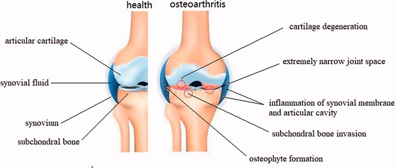 Fig.1 Schematic representation of healthy knee joint structure and pathological changes of knee osteoarthritis. (Mao, Liwei, et al, 2021)