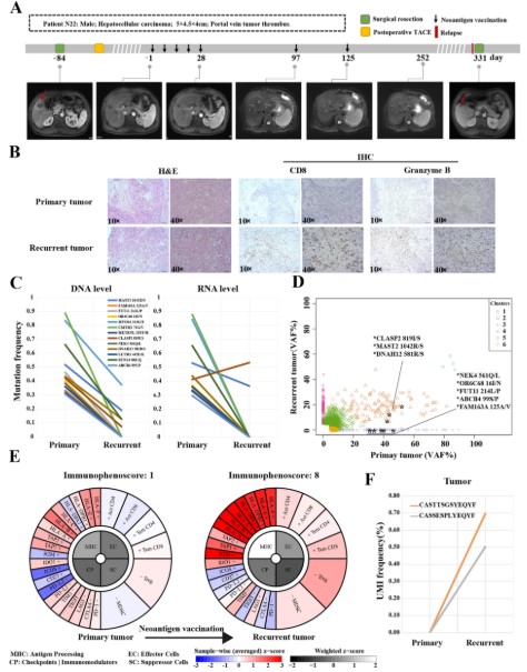 Clinical response and immune microenvironment dynamics in HCC patients undergoing neoantigen vaccination and follow-up.