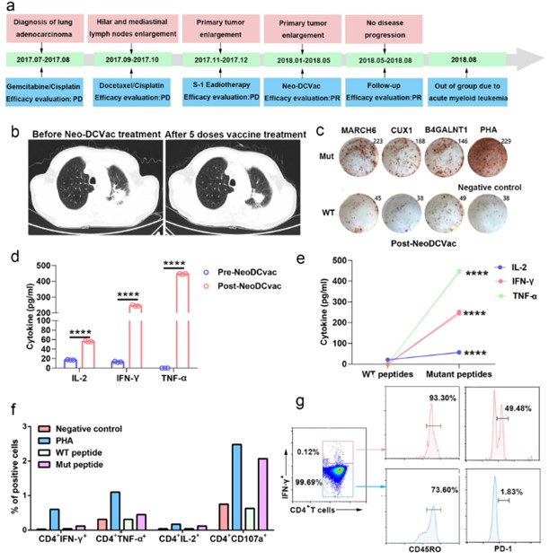 Clinical and immune responses to personalized Neo-DCVac therapy in patient 1 with metastatic lung adenocarcinoma.
