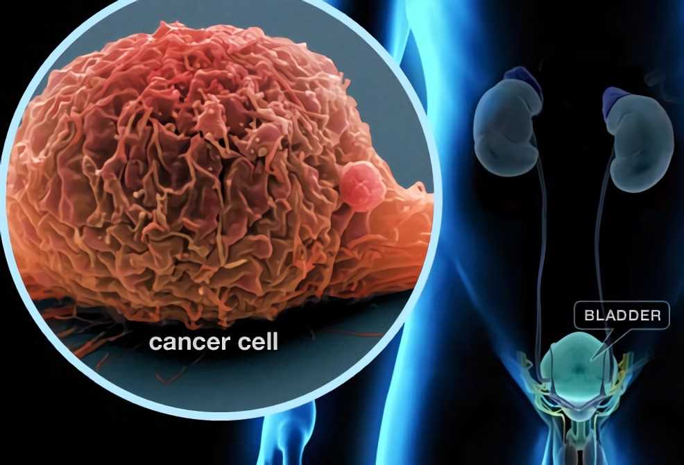 Bladder Cancer – Creative Biolabs