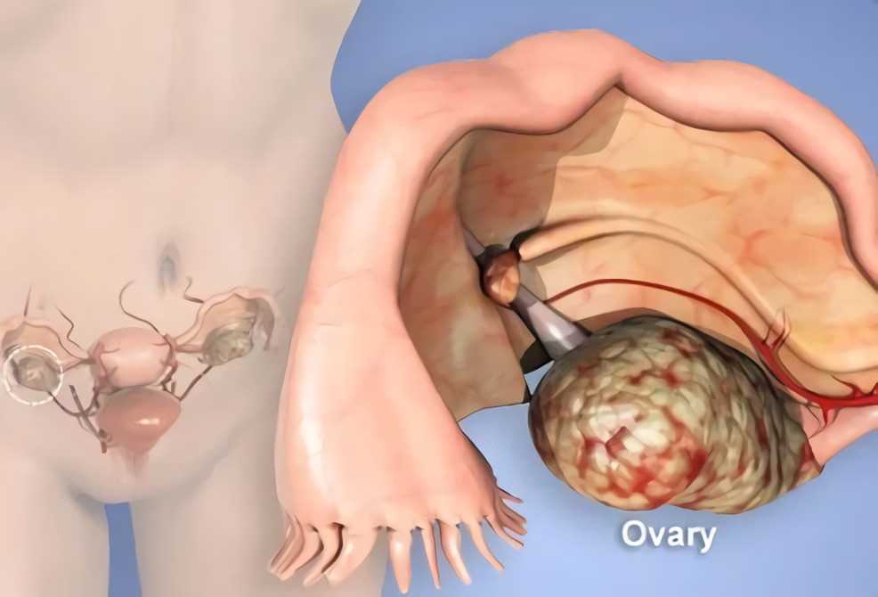 Ovarian Cancer – Creative Biolabs