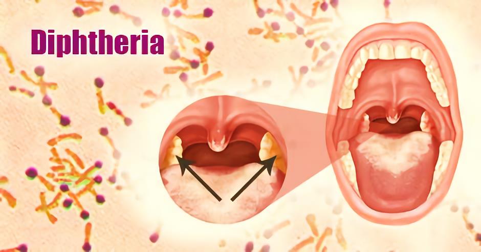 Corynebacterium dephtherae Vaccines - Creative Biolabs
