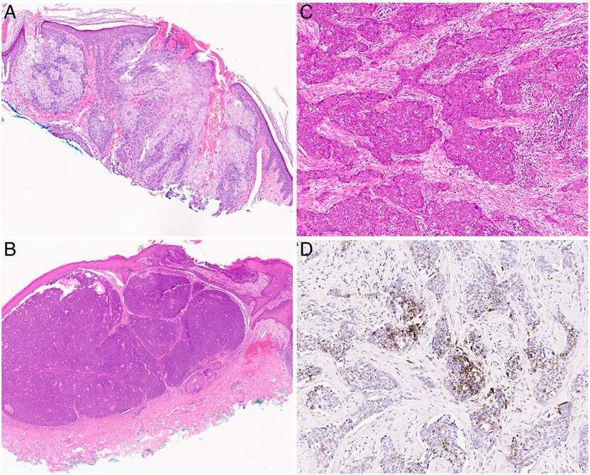 Cutaneous adnexal neoplasms with sebaceous differentiation