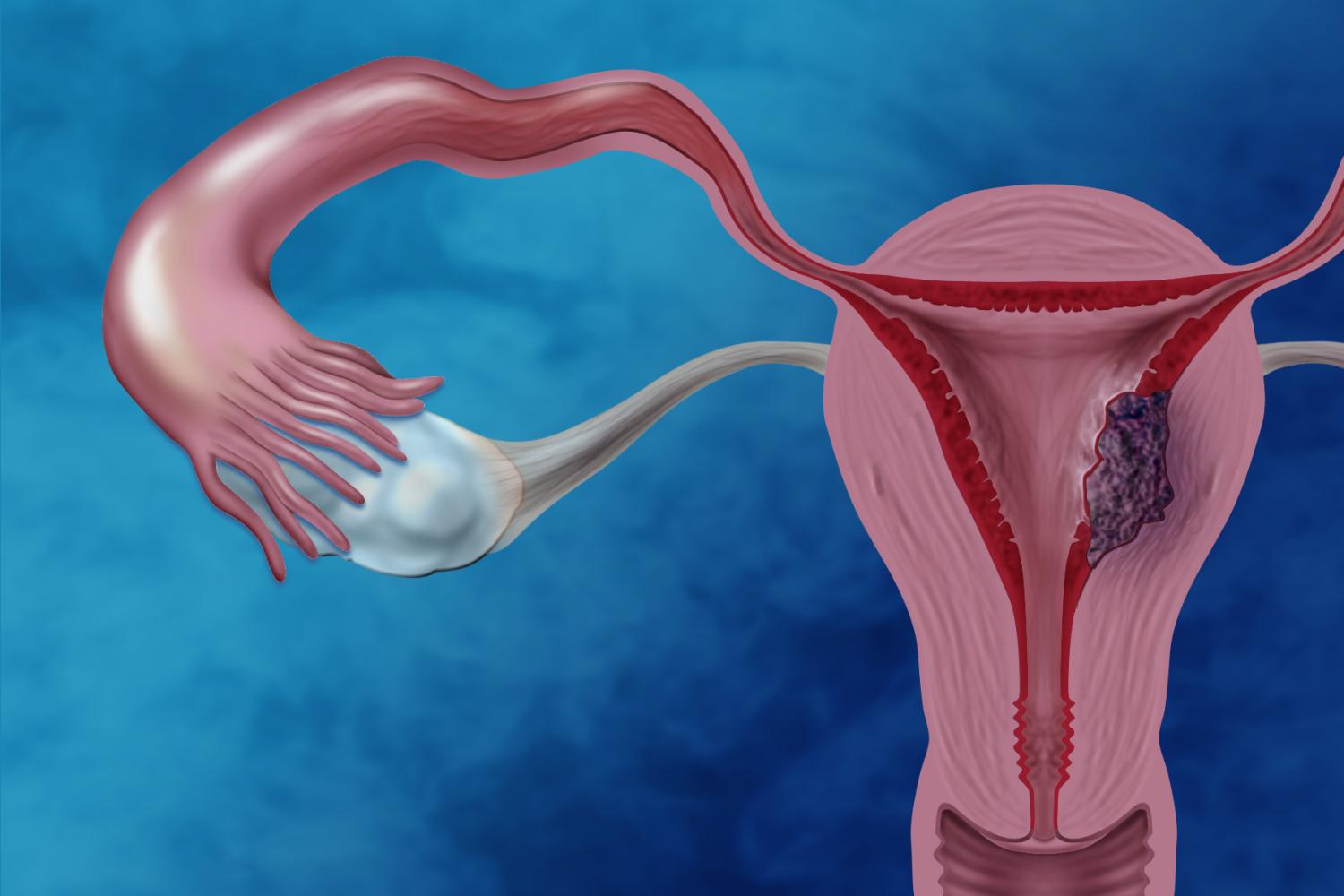 Endometrial Cancer- Creative Biolabs
