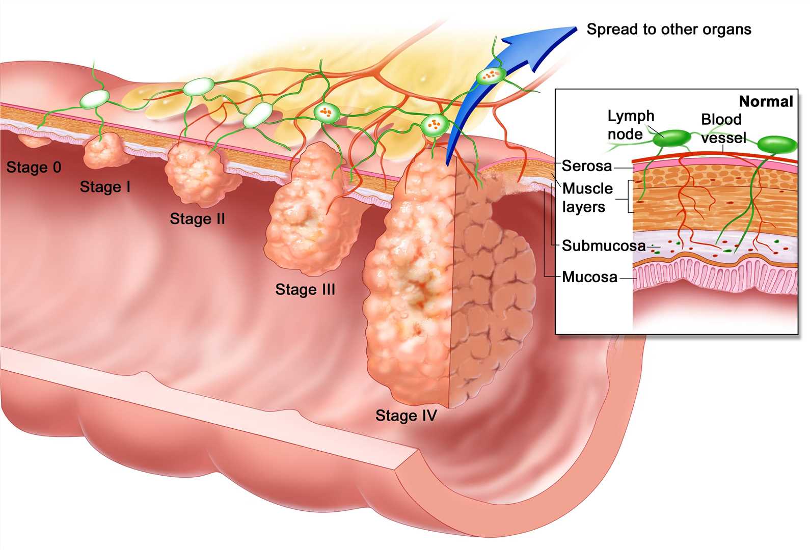 esophageal cancer and hpv)