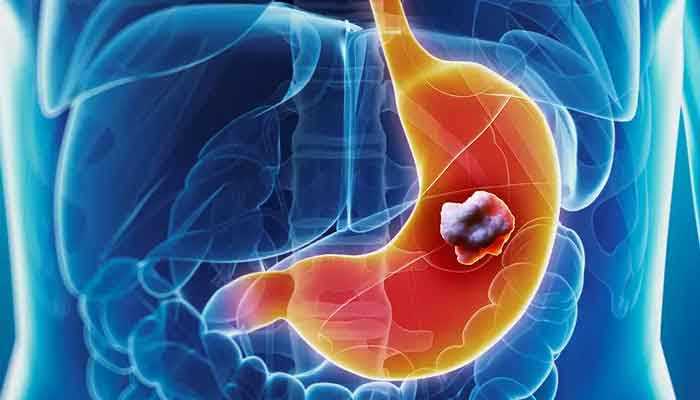 gastric cancer vaccine