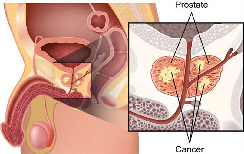 Prostate Cancer – Creative Biolabs
