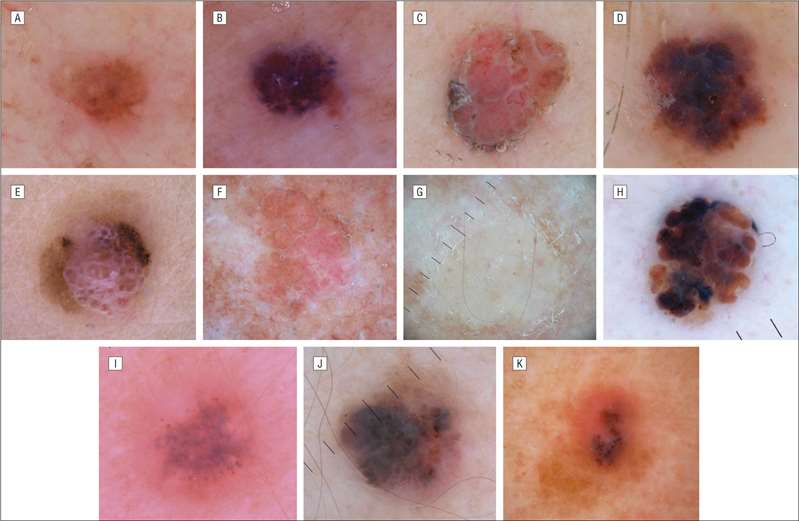 Clinical images of thin nodular melanoma lesions