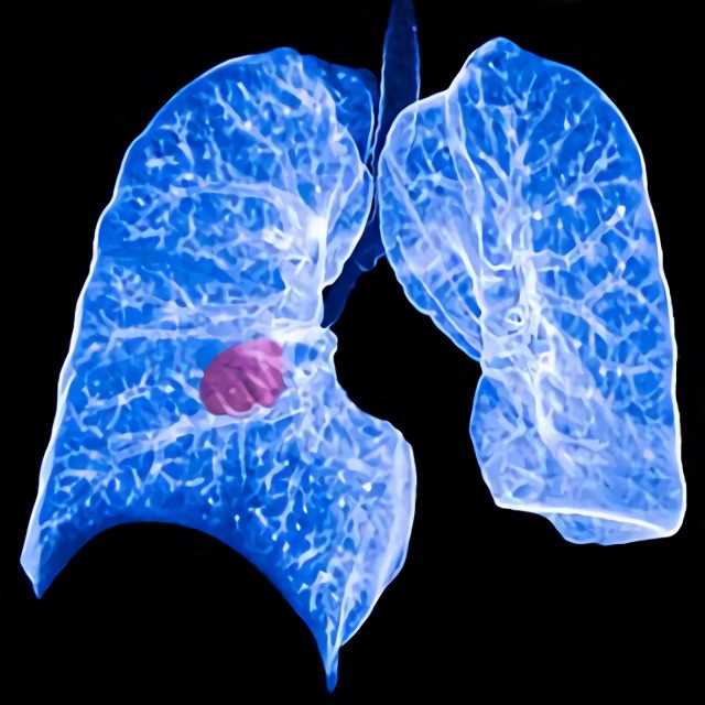 Small Cell Lung Cancer – Creative Biolabs