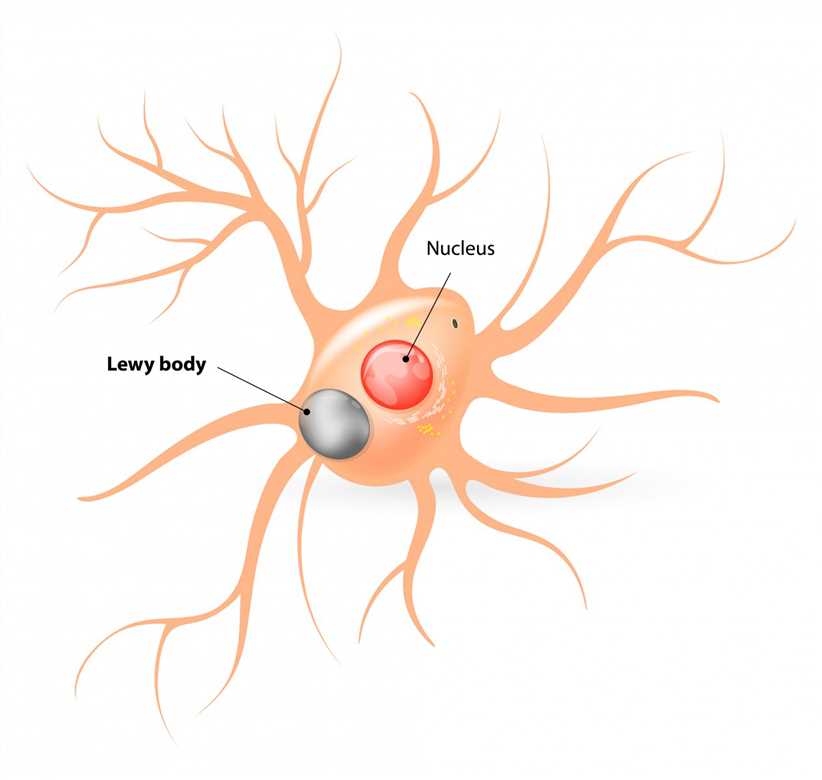 Lewy Body Disease. – Creative Biolabs