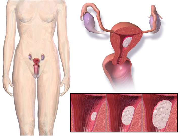 Vaginal Cancer - Creative Biolabs
