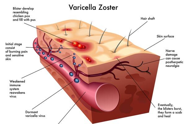 Varicella Zoster Virus Vaccines